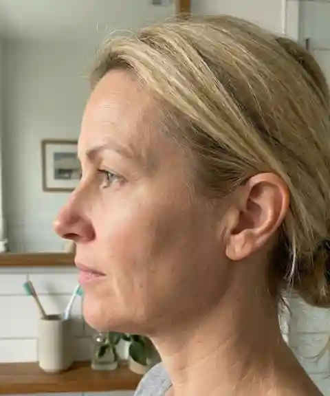 Before — Neck and jaw toning