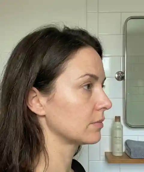 Before — Facial symmetry