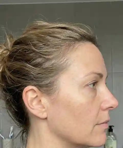 Before — Skin firmness