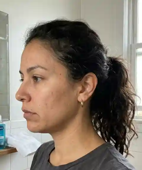 Before — Cheekbone lift