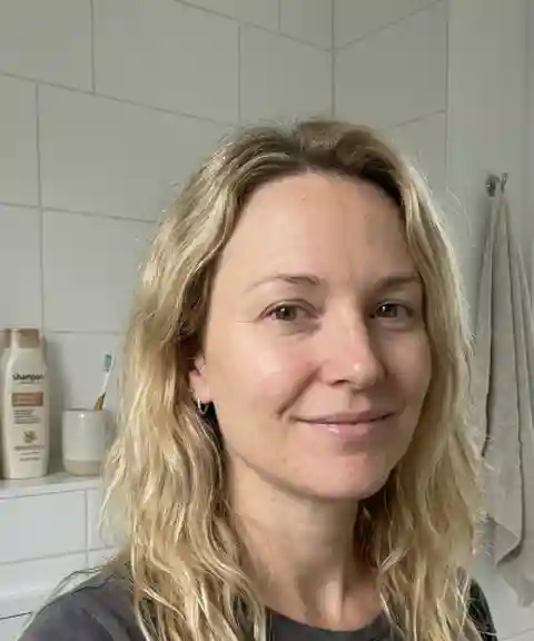 Before — Forehead smoothing