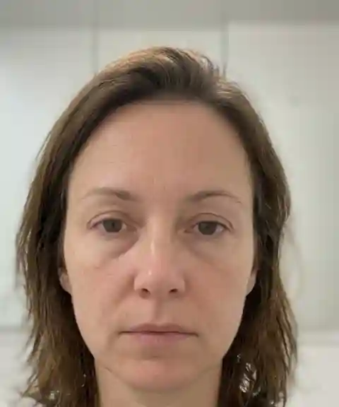 Before — Under-eye improvement